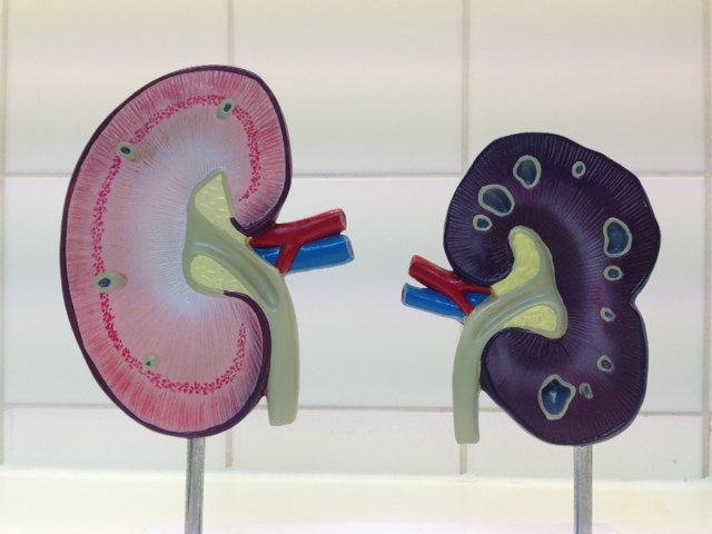 Links een gezonde nier | rechts een verschrompelde nier