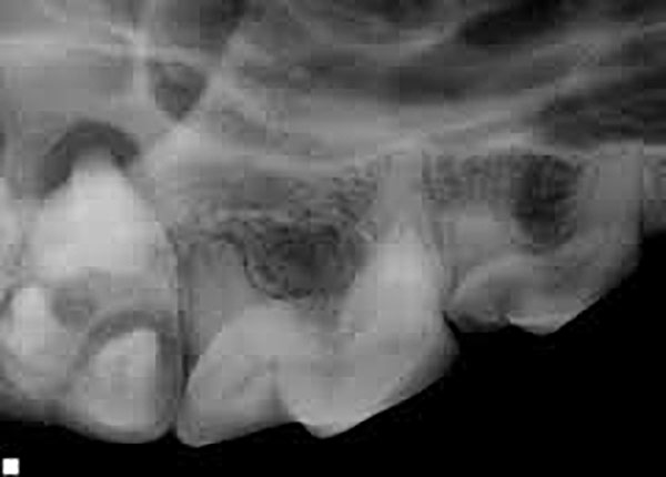 Dentale röntgen foto